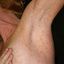 3. Pitiriasis rosada bajo el brazo foto