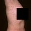 7. Pitiriasis rosada bajo el brazo foto