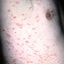8. Pitiriasis rosada bajo el brazo foto