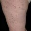 18. Pitiriasis rosada en la pierna foto