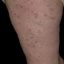19. Pitiriasis rosada en la pierna foto