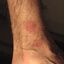 2. Pitiriasis rosada en la pierna foto