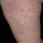 20. Pitiriasis rosada en la pierna foto
