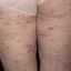 22. Pitiriasis rosada en la pierna foto