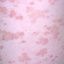 4. Pitiriasis rosada en la pierna foto