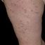 5. Pitiriasis rosada en la pierna foto