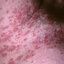 102. Pitiriasis rosada foto