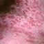 103. Pitiriasis rosada foto