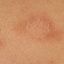 106. Pitiriasis rosada foto