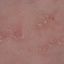 51. Pitiriasis rosada foto