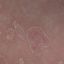 65. Pitiriasis rosada foto