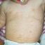 23. Pitiriasis rosada en los niños foto