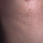 Queratosis