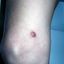 23. Dermatofibroma en la pierna foto