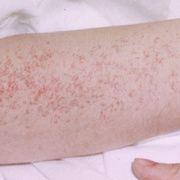 Varices